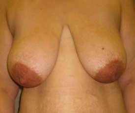 Manhattan Breast Reduction before 2